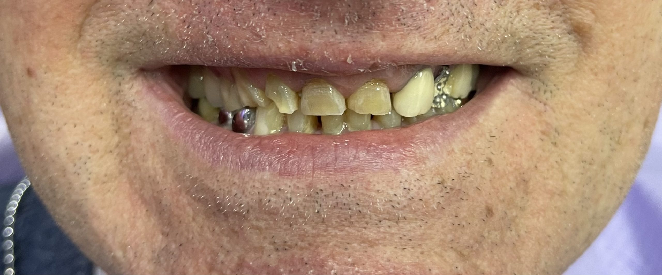 Protetica dentara reabilitare orala