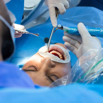 chirurgie dentara